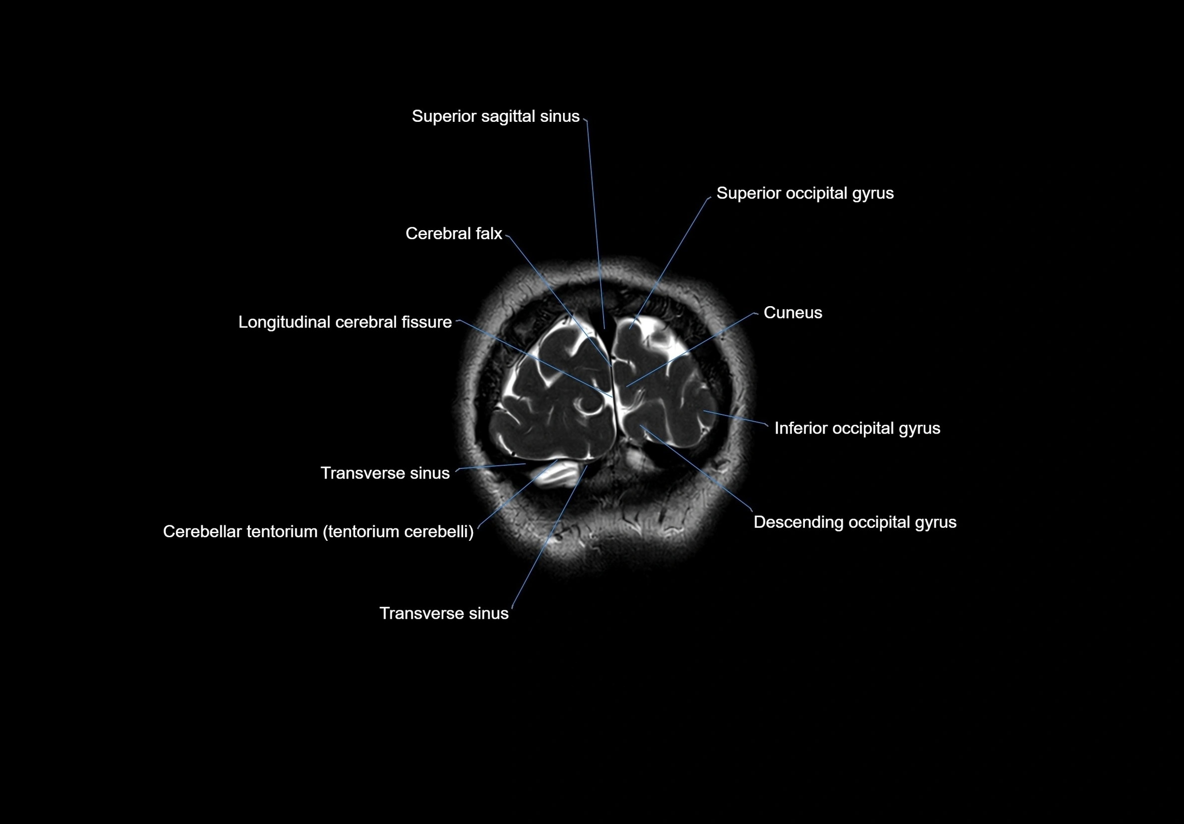 MRI Brain coronal cross sectional labelled anatomy 3T image  -img-00001-00070.webp